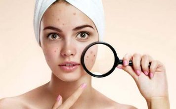 Названы главные причины появления прыщей