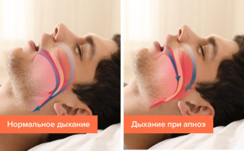 Разновидности апноэ сна. Какими последствиями для человека оно опасно?