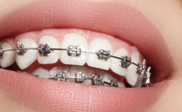 разновидности ортодонтических брекет-систем