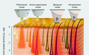 Лазерная эпиляция. Какой лазер лучше.
