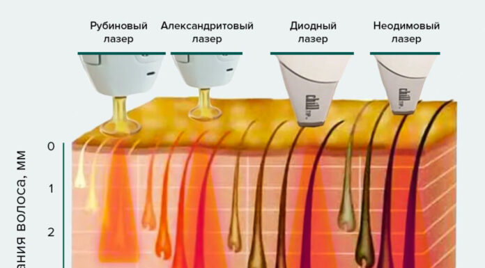 Лазерная эпиляция. Какой лазер лучше.