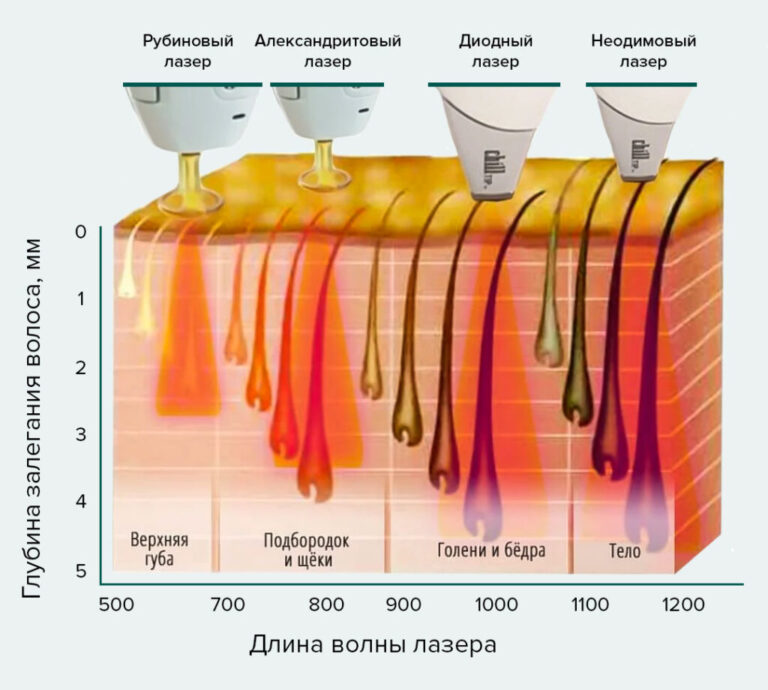 Какой Лазерный Аппарат Для Эпиляции Лучше Купить