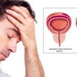 Особливості лікування аденоми простати