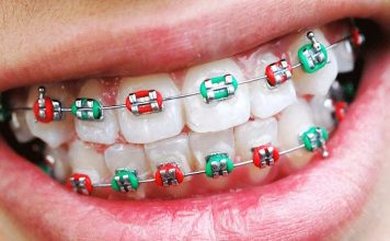 Брекеты: всё, что вы хотели знать, но боялись спросить
