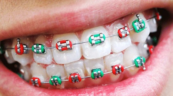Брекеты: всё, что вы хотели знать, но боялись спросить