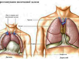 симптоми раку тимуса