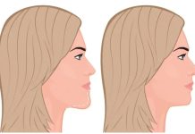 Уменьшение подбородка: как исправить то, что мешает нравиться себе в зеркале Уменьшение подбородка