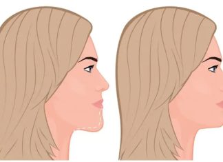 Уменьшение подбородка: как исправить то, что мешает нравиться себе в зеркале Уменьшение подбородка