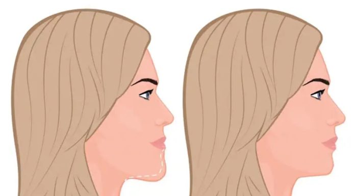 Уменьшение подбородка: как исправить то, что мешает нравиться себе в зеркале Уменьшение подбородка